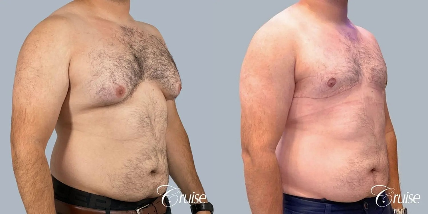 Gynecomastia Surgery Before & After