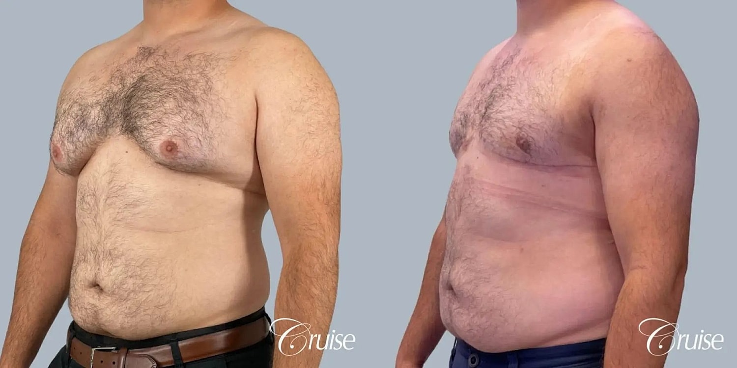 Gynecomastia Surgery Before & After