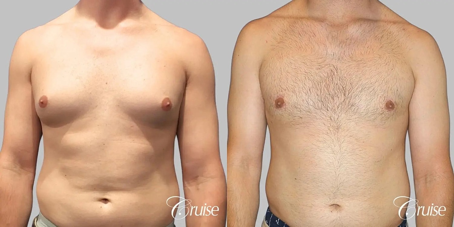 Gynecomastia Surgery Before & After