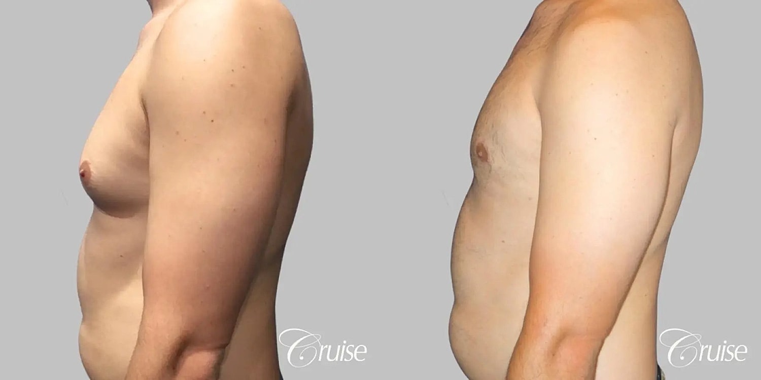 Gynecomastia Surgery Before & After