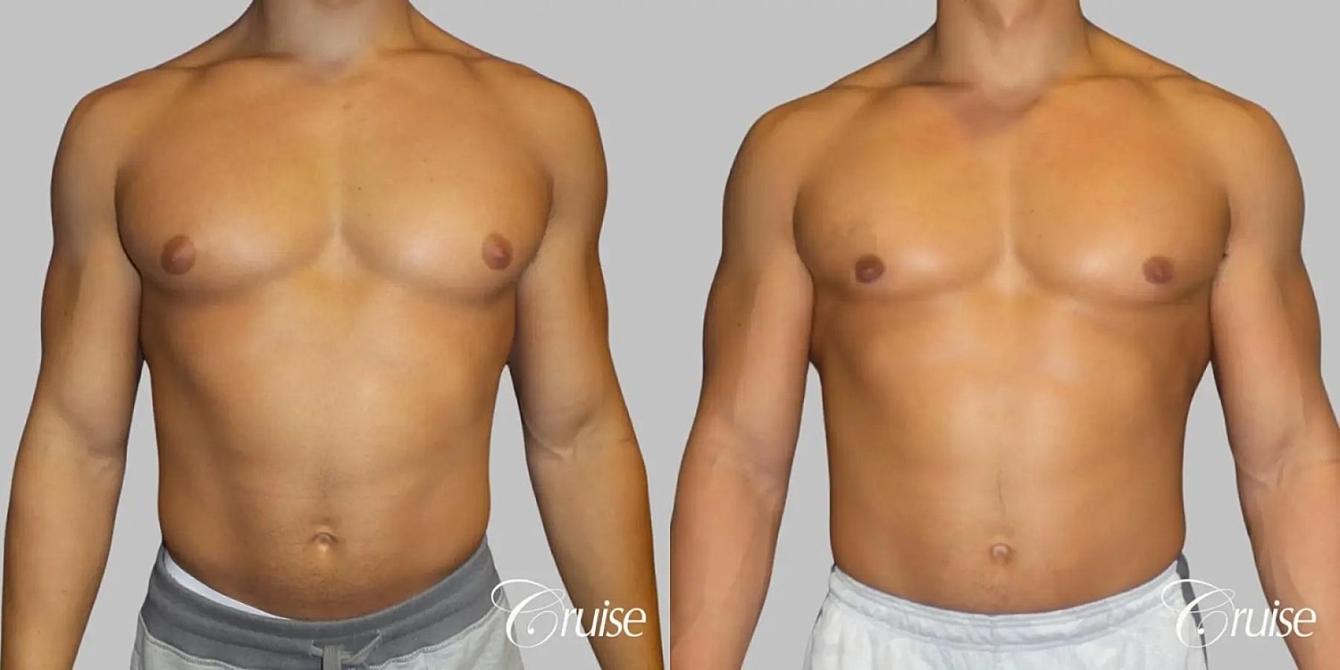 Gynecomastia Surgery Before & After