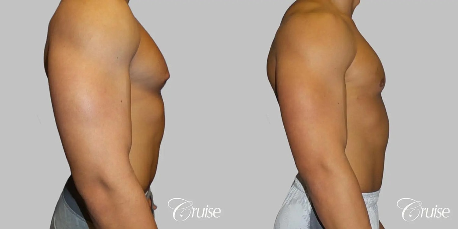 Gynecomastia Surgery Before & After