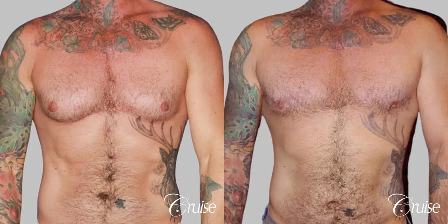 Gynecomastia Surgery Before & After
