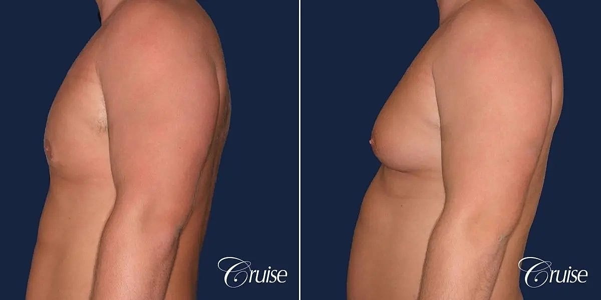 Gynecomastia Surgery Before & After