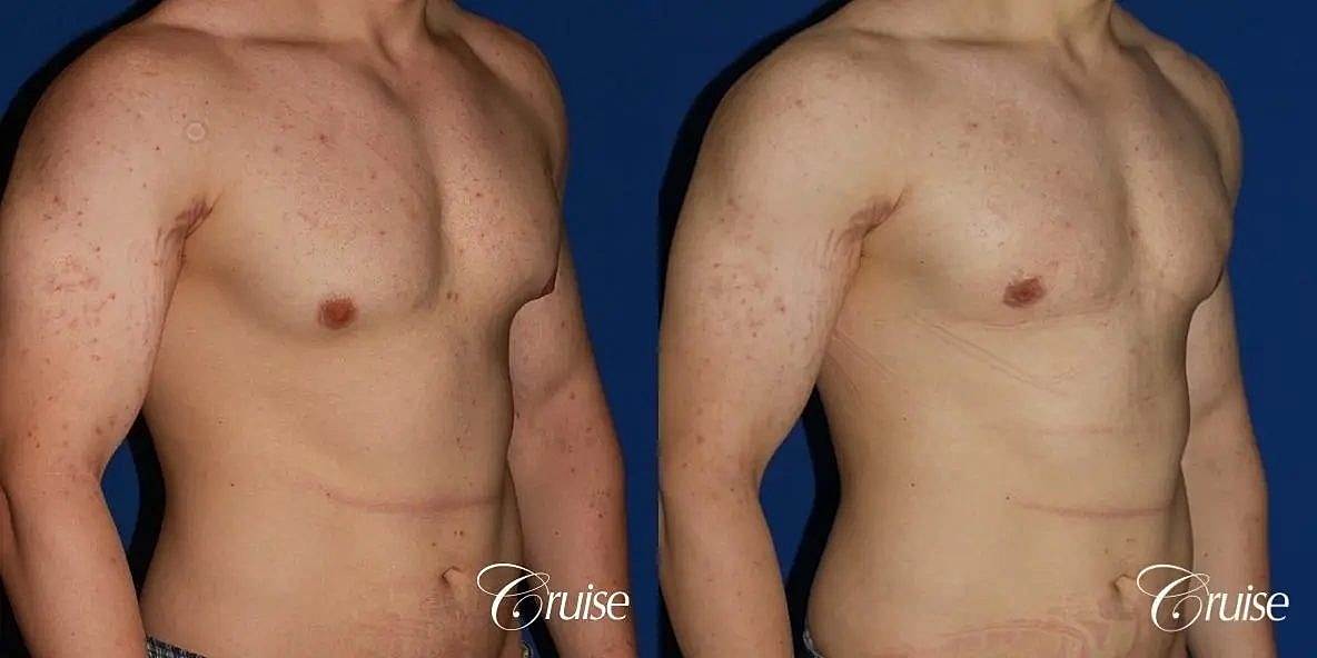 Gynecomastia Surgery Before & After