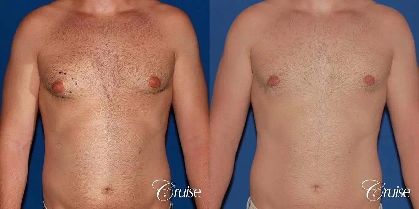 Gynecomastia Surgery Before & After