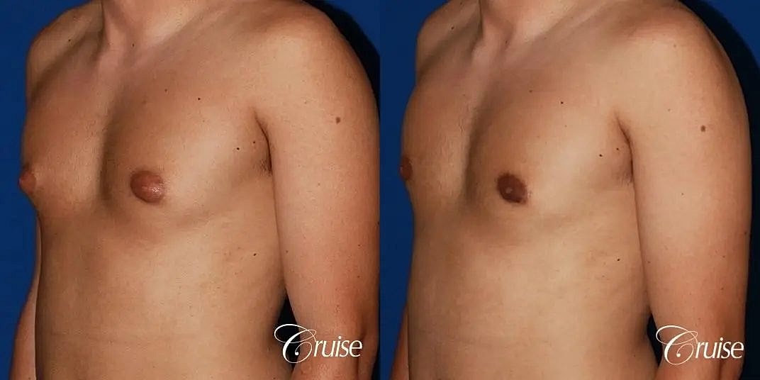 Gynecomastia Surgery Before & After