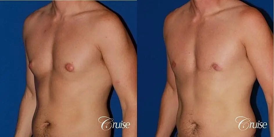 Gynecomastia Surgery Before & After
