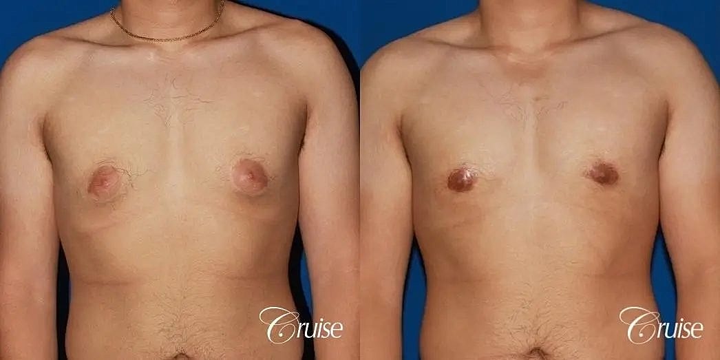 Gynecomastia Surgery Before & After