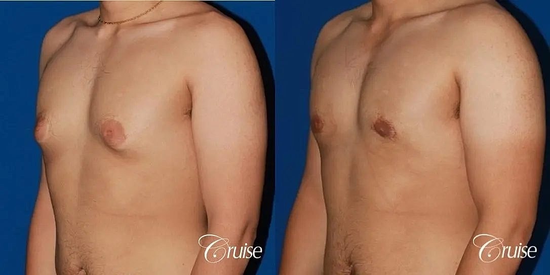 Gynecomastia Surgery Before & After
