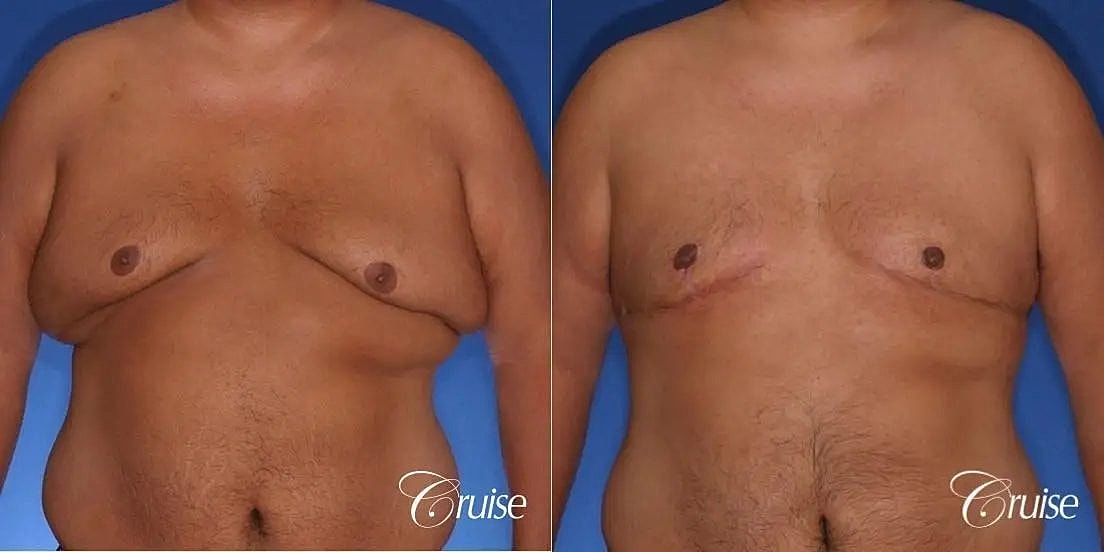 Gynecomastia Surgery Before & After