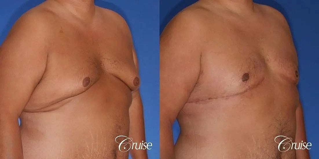 Gynecomastia Surgery Before & After