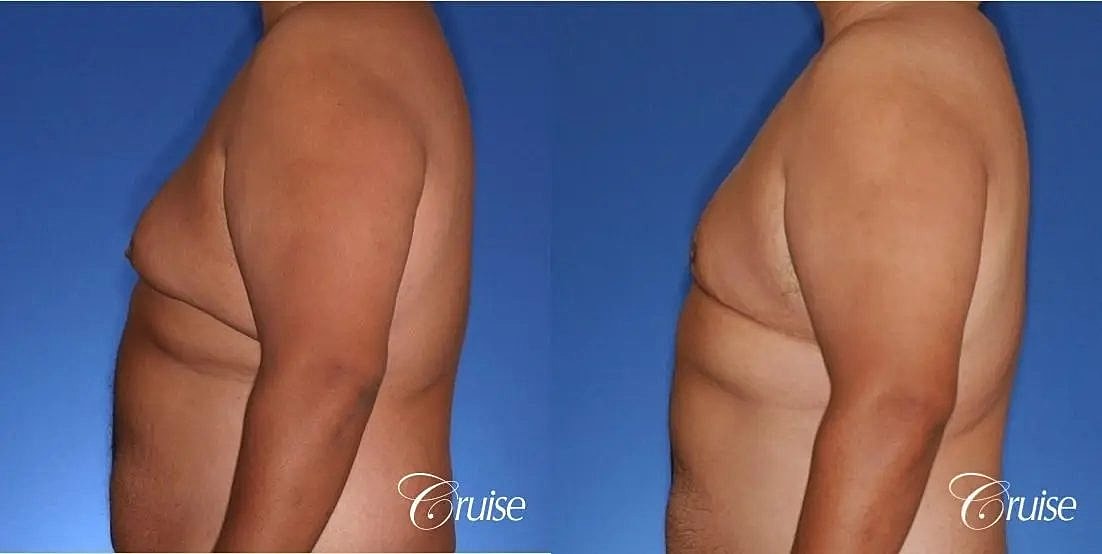 Gynecomastia Surgery Before & After