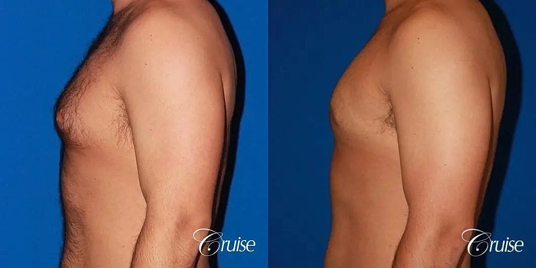 Gynecomastia Surgery Before & After