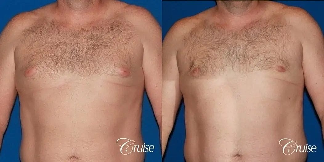 Gynecomastia Surgery Before & After