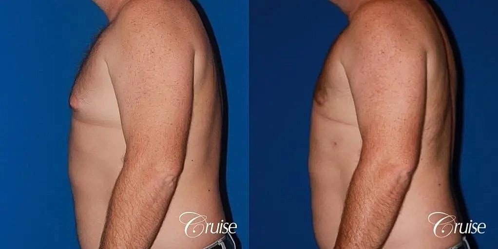 Gynecomastia Surgery Before & After