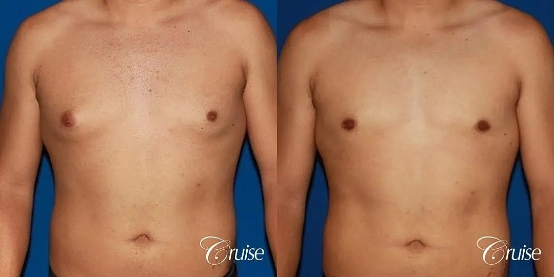 Gynecomastia Surgery Before & After