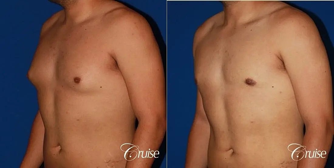 Gynecomastia Surgery Before & After