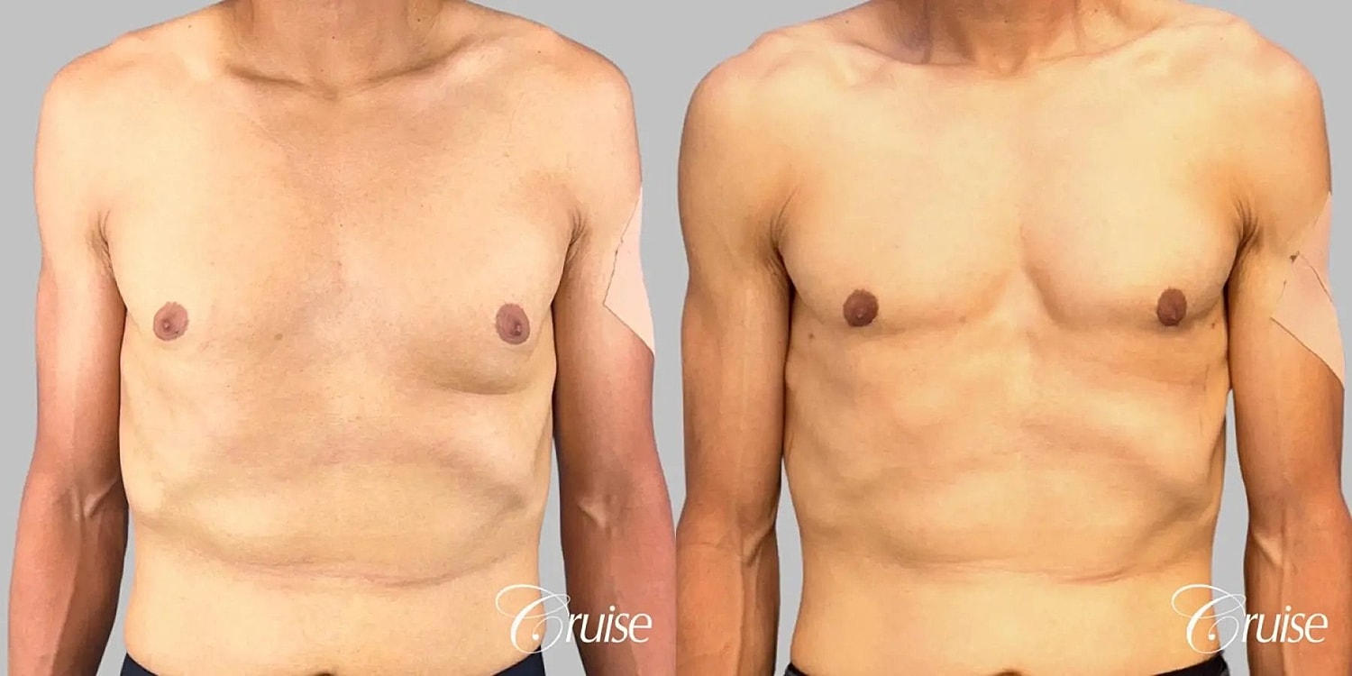 Gynecomastia Surgery Before & After