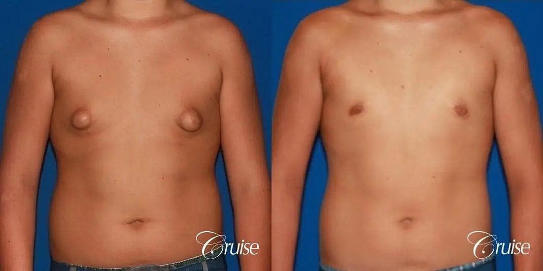 Gynecomastia Surgery Before & After
