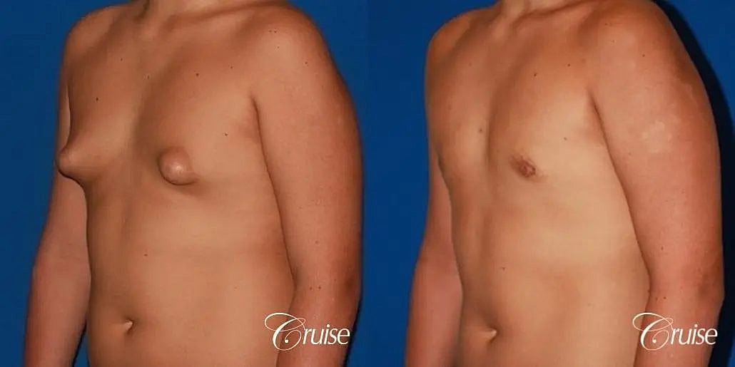 Gynecomastia Surgery Before & After