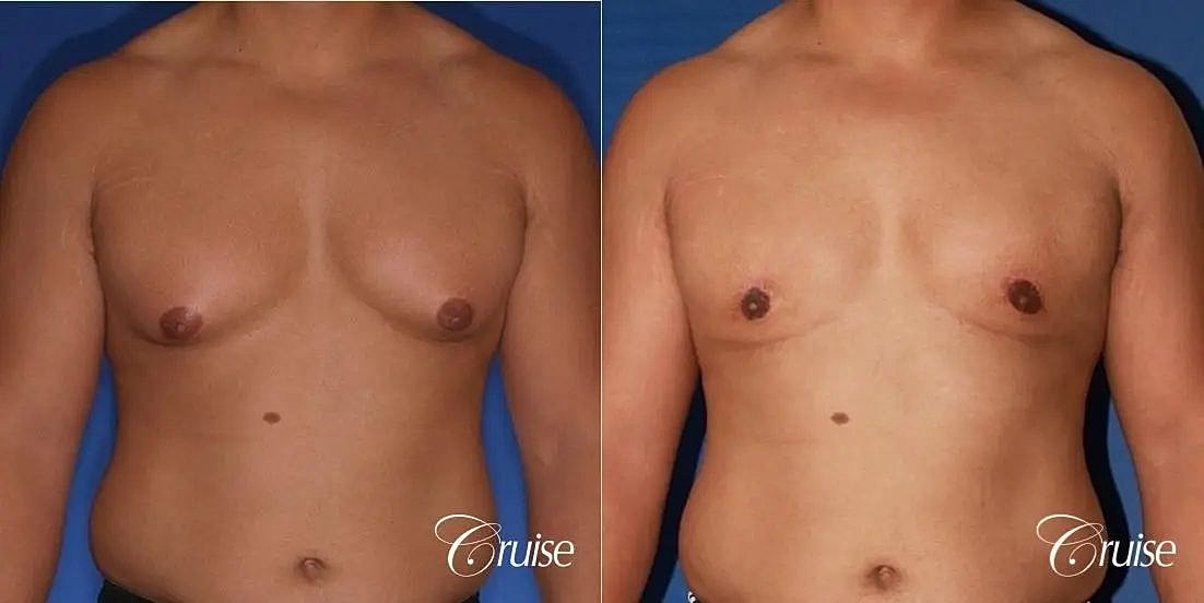 Gynecomastia Surgery Before & After