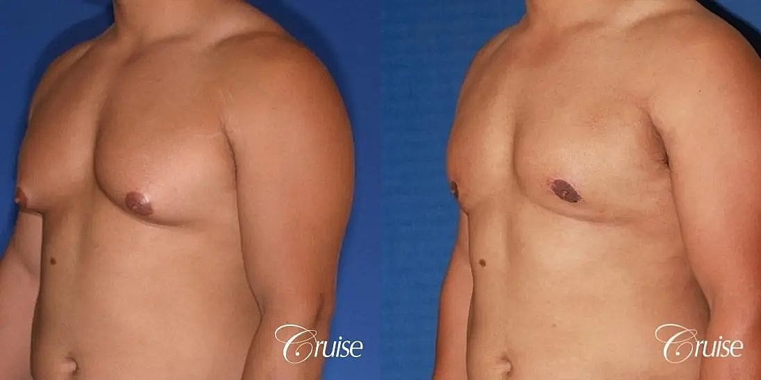 Gynecomastia Surgery Before & After