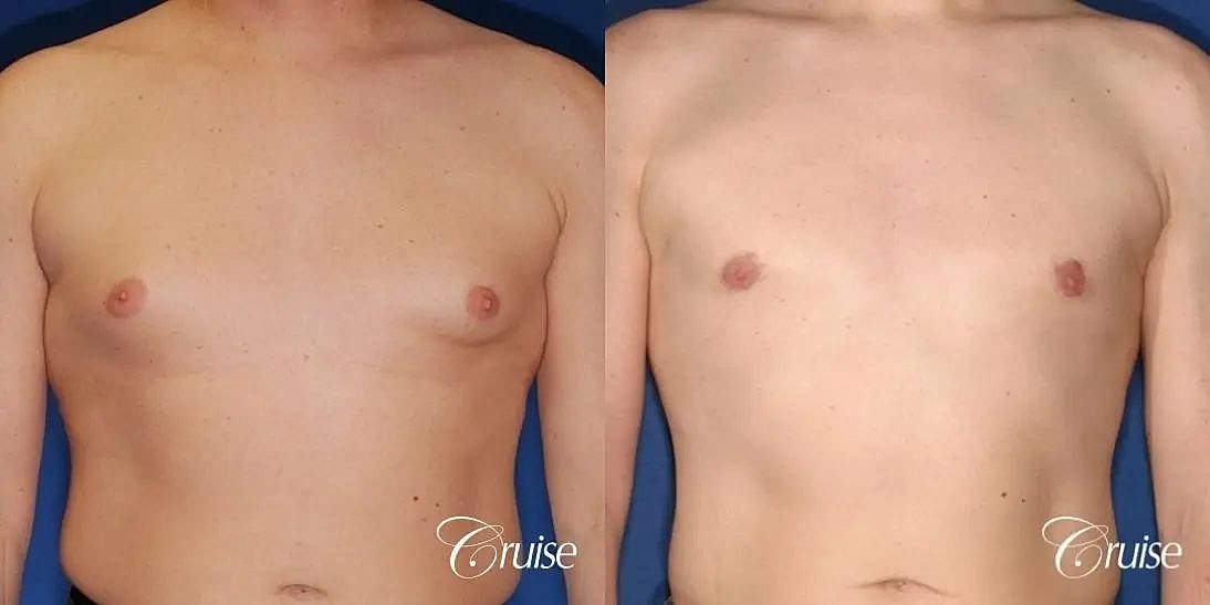 Gynecomastia Surgery Before & After