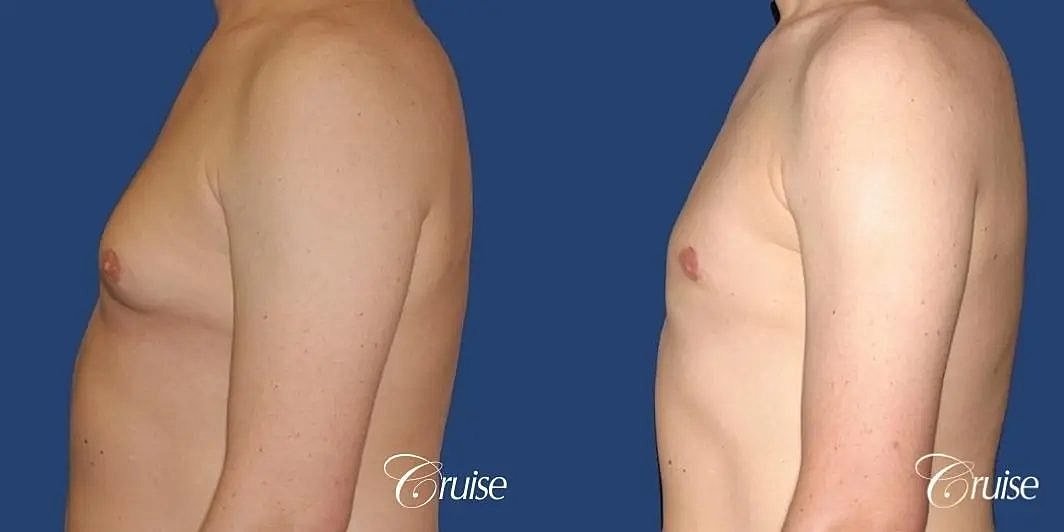 Gynecomastia Surgery Before & After