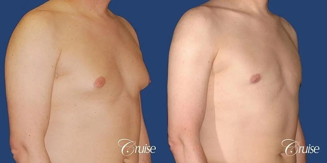 Gynecomastia Surgery Before & After