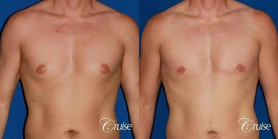 Gynecomastia Surgery Before & After
