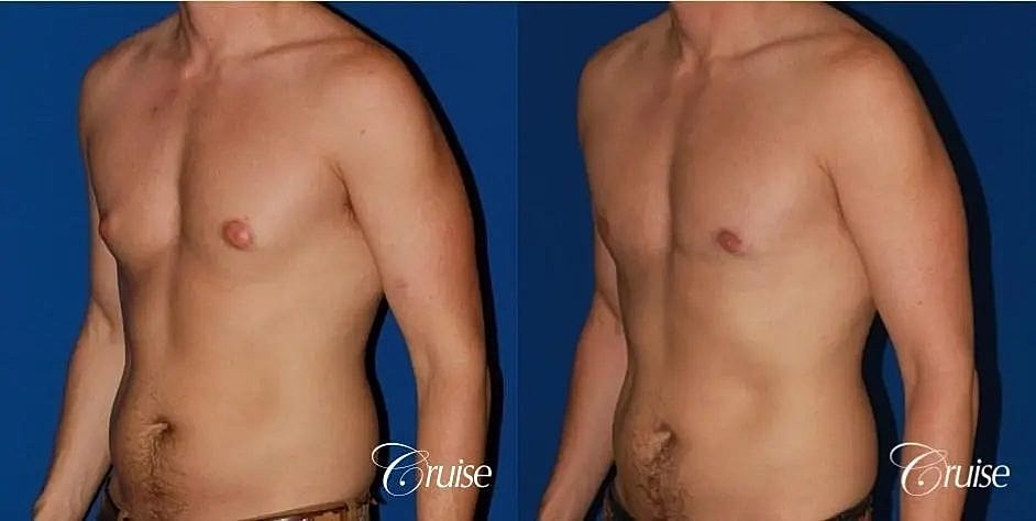 Gynecomastia Surgery Before & After