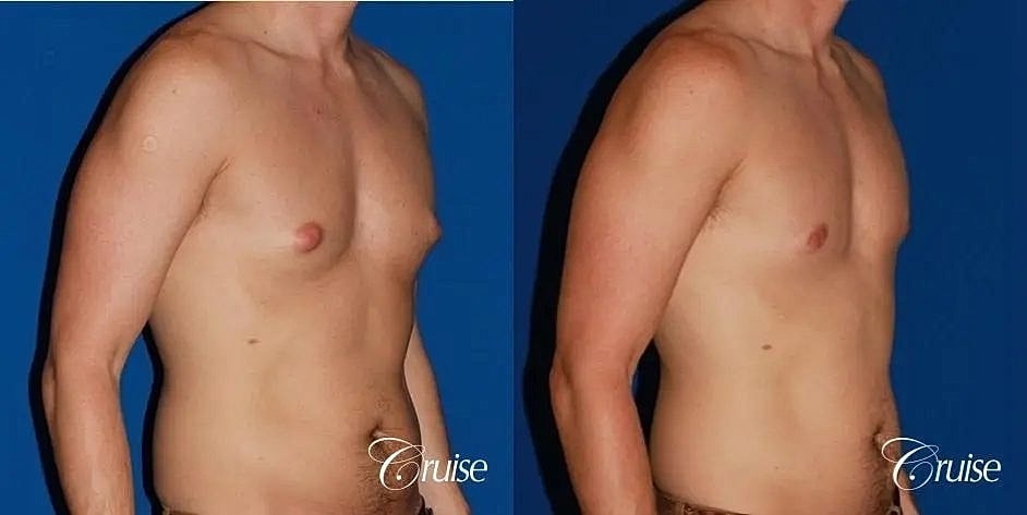 Gynecomastia Surgery Before & After