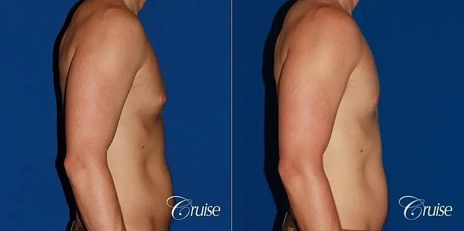 Gynecomastia Surgery Before & After