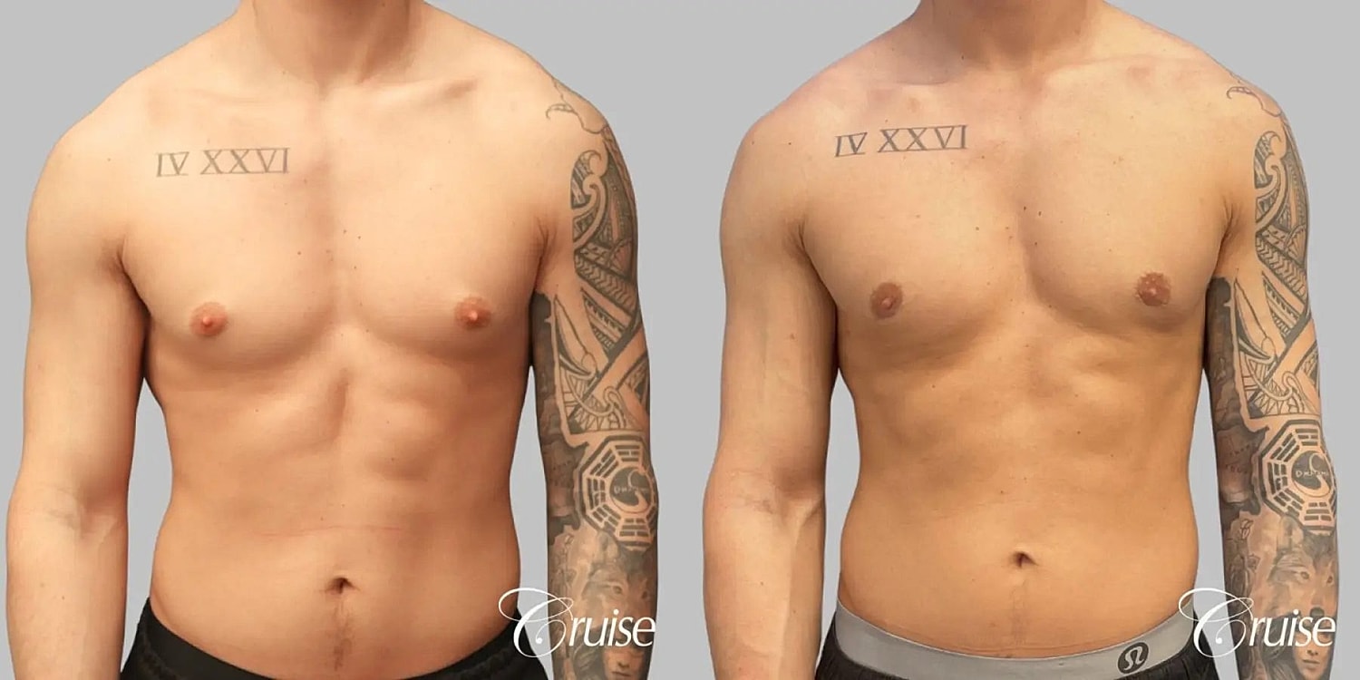 Gynecomastia Surgery Before & After