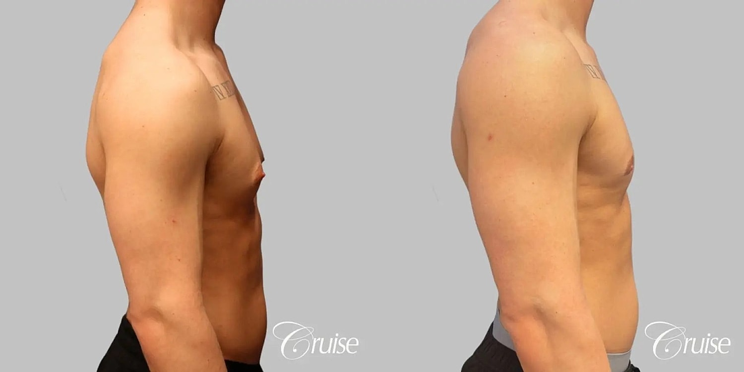 Gynecomastia Surgery Before & After