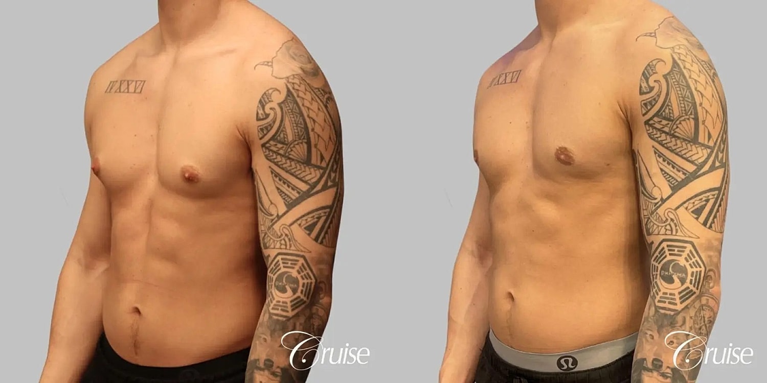 Gynecomastia Surgery Before & After