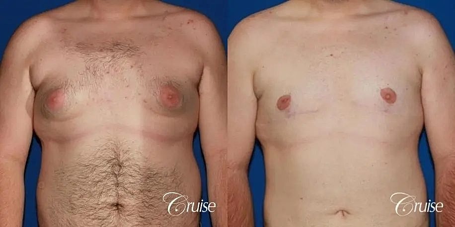 Gynecomastia Surgery Before & After