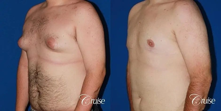Gynecomastia Surgery Before & After