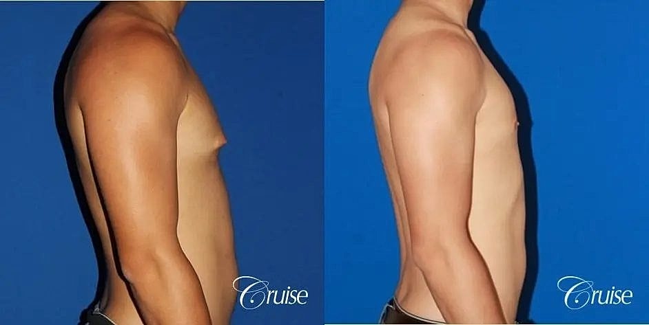 Gynecomastia Surgery Before & After