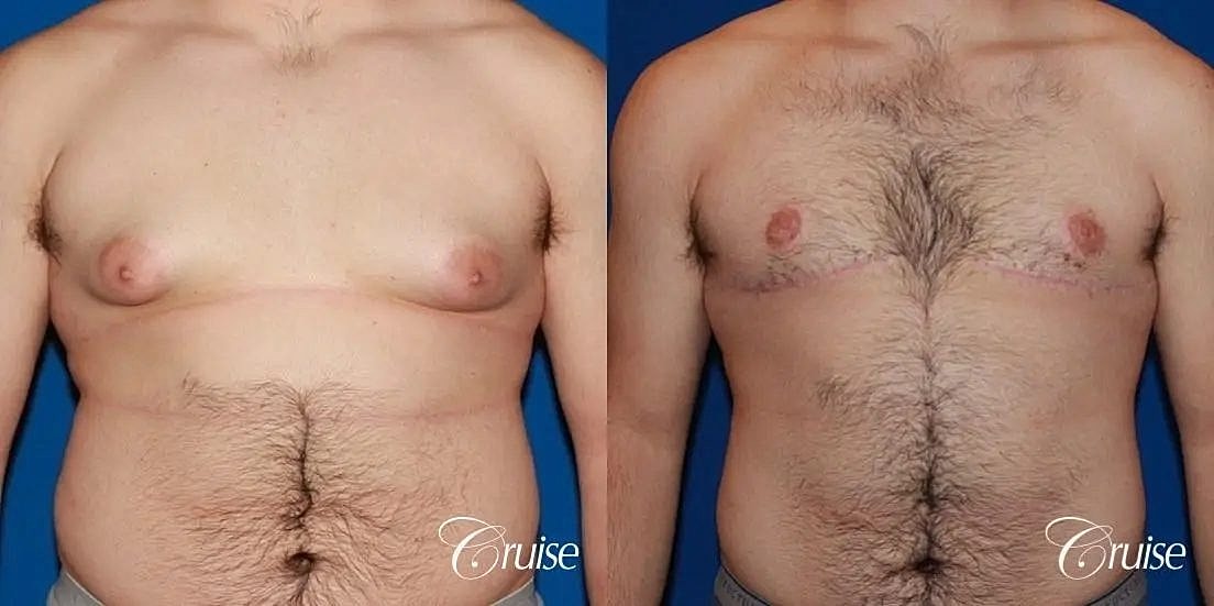 Gynecomastia Surgery Before & After
