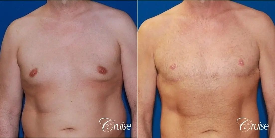 Gynecomastia Surgery Before & After