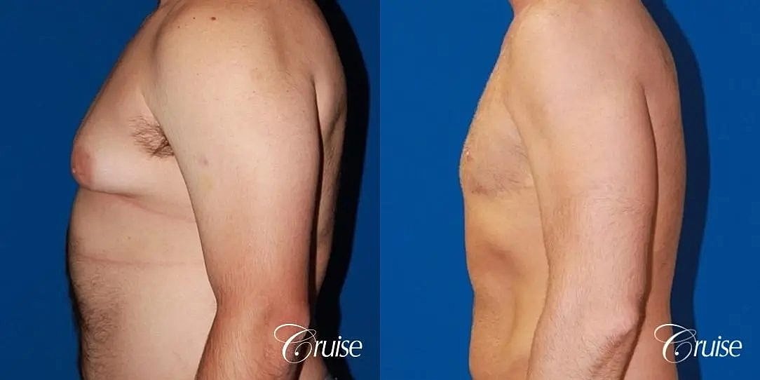 Gynecomastia Surgery Before & After
