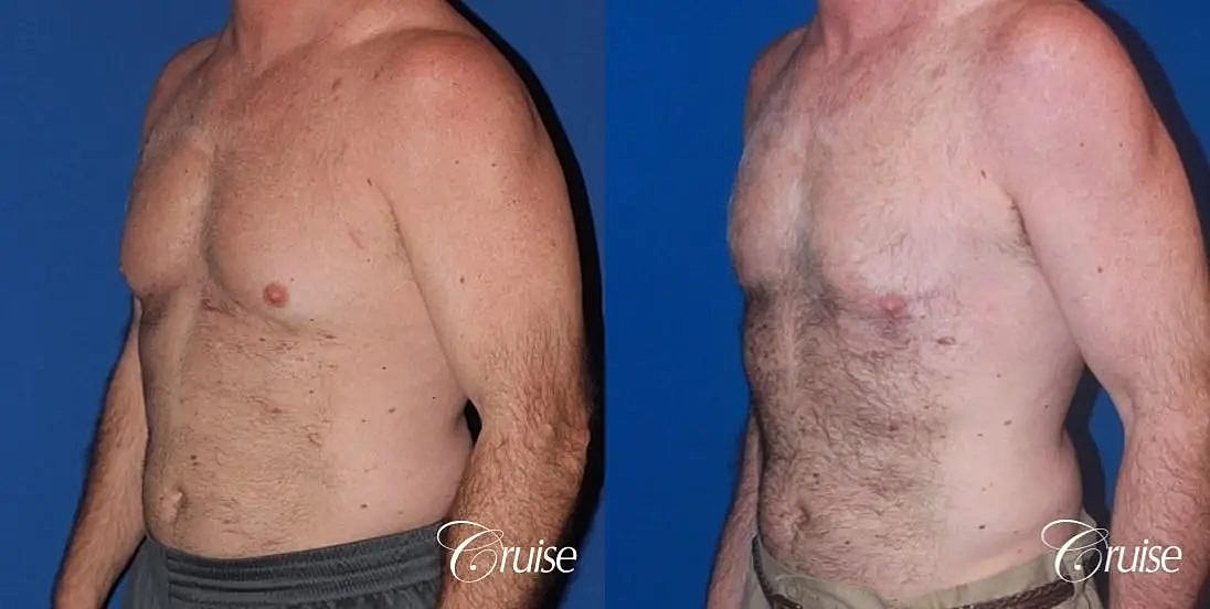 Gynecomastia Surgery Before & After