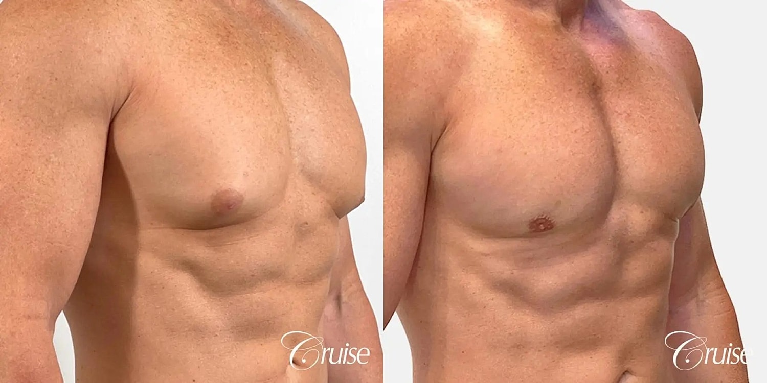Gynecomastia Surgery Before & After
