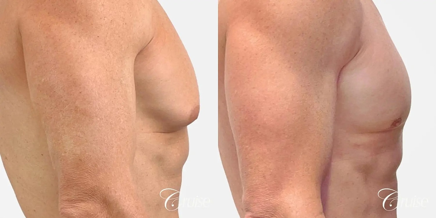 Gynecomastia Surgery Before & After