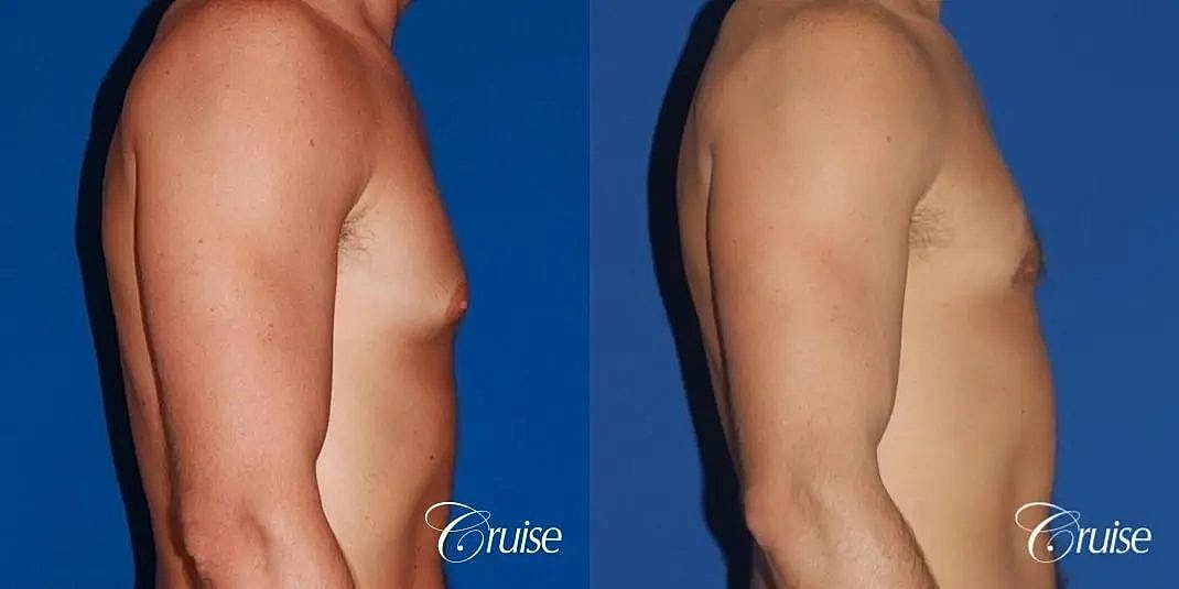 Gynecomastia Surgery Before & After