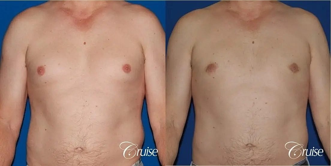 Gynecomastia Surgery Before & After