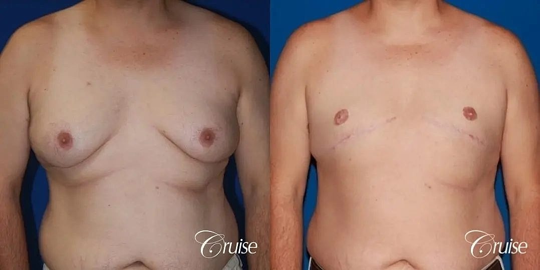 Gynecomastia Surgery Before & After