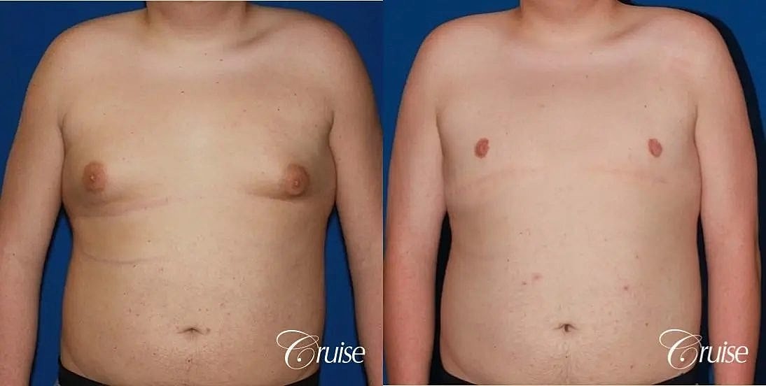 Gynecomastia Surgery Before & After